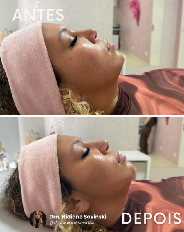 Antes e depois de harmonização facial