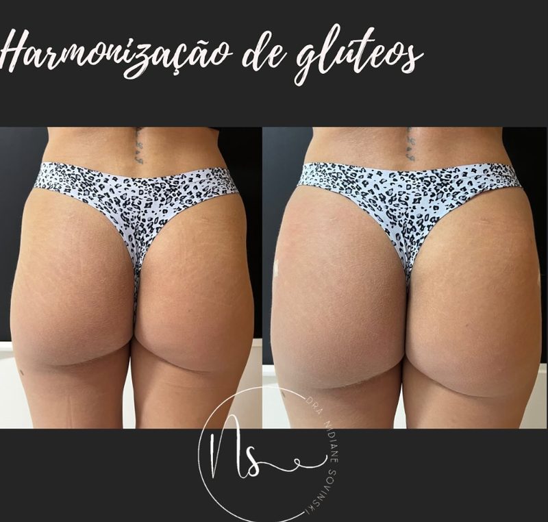 Antes e depois de harmonização glútea