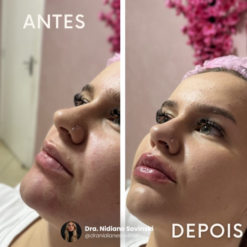 Antes e depois de preenchimento labial